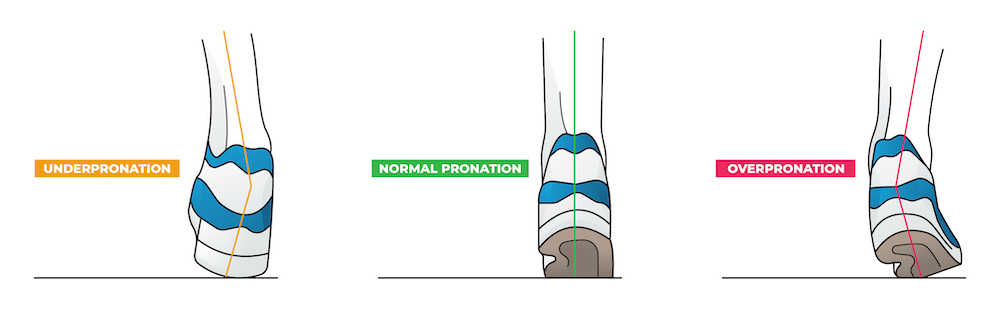 pronation types